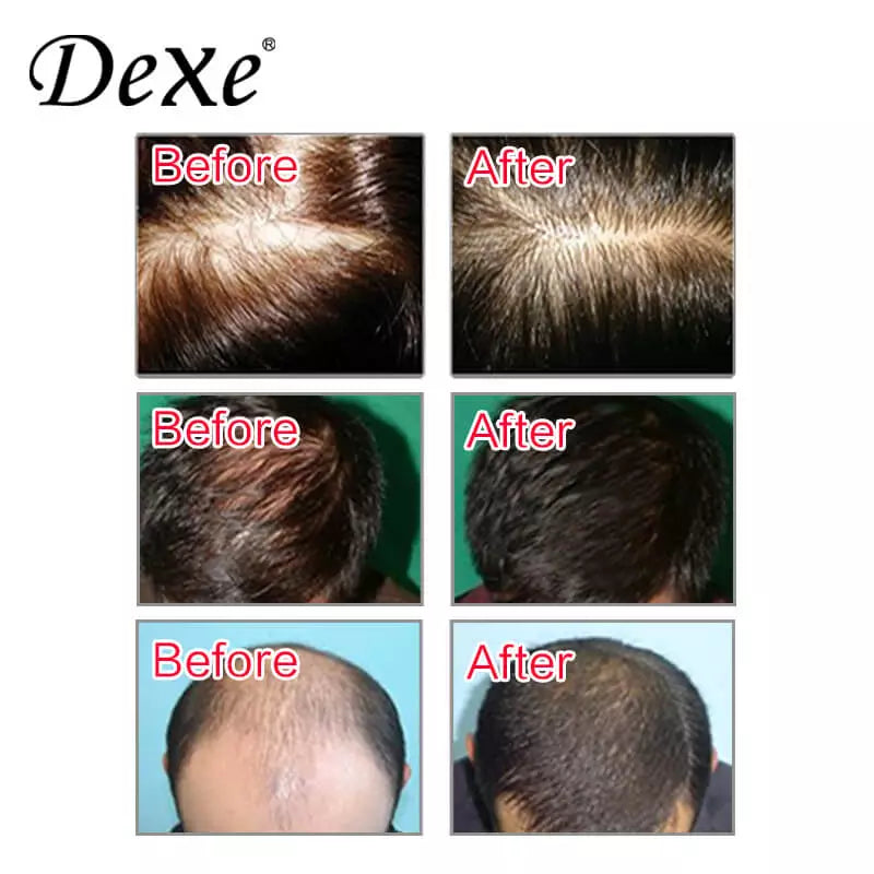 Dexe Anti-Hair Loss Shampoo 200 ml